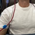 Detailed Accounts of Successful Treatments for Extracorporeal Blood Oxygenation and Ozonation